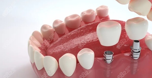 佛山种植牙1000左右的价格靠谱吗