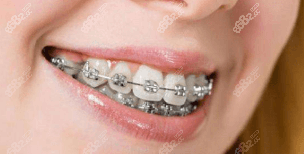 牙齿矫正 牙齿矫正
