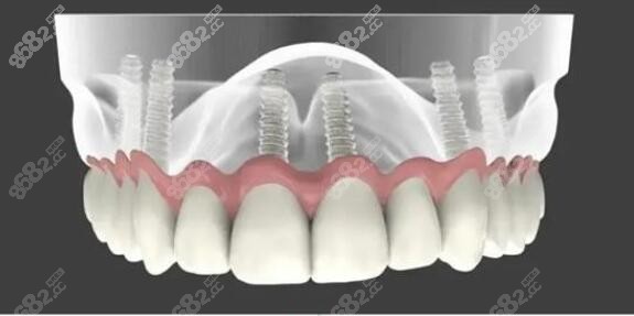 南京金铂利口腔种植牙技术：即刻种植