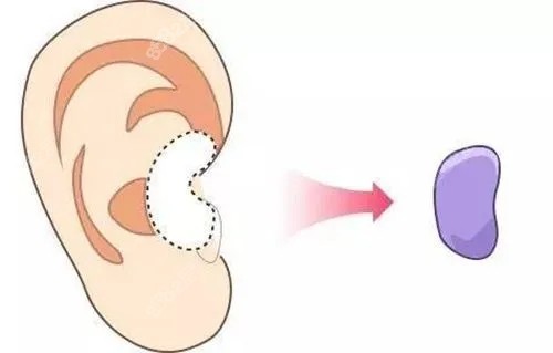 合肥维多利亚整形做耳朵技术优势