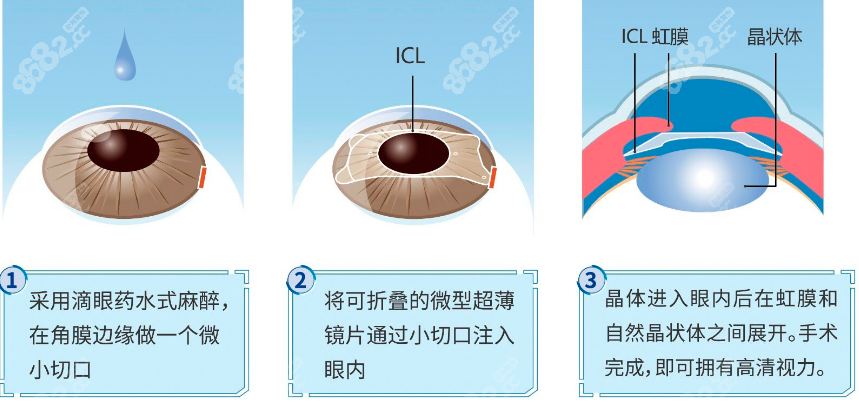 杭州太学眼科晶体植入手术m.8682.cc