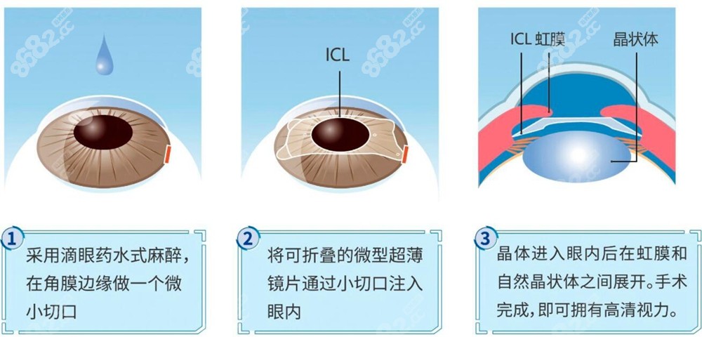 普瑞眼科医院近视icl晶体植入手术