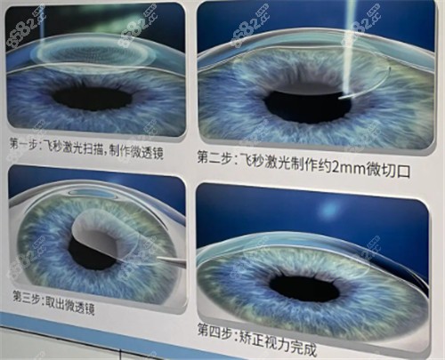 近视眼手术步骤图