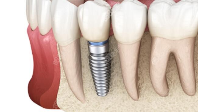 种植牙的牙根会支撑到牙龈下 种植牙的牙根会支撑到牙龈下