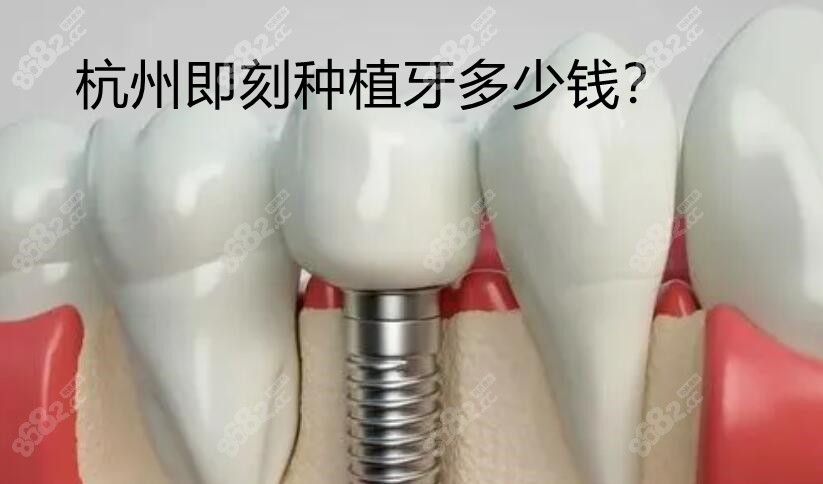 杭州即刻种植牙多少钱www.8682.cc