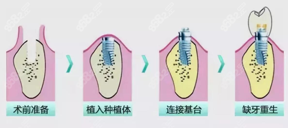 即刻种植牙的过程