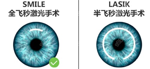 全飞秒和半飞秒手术去别