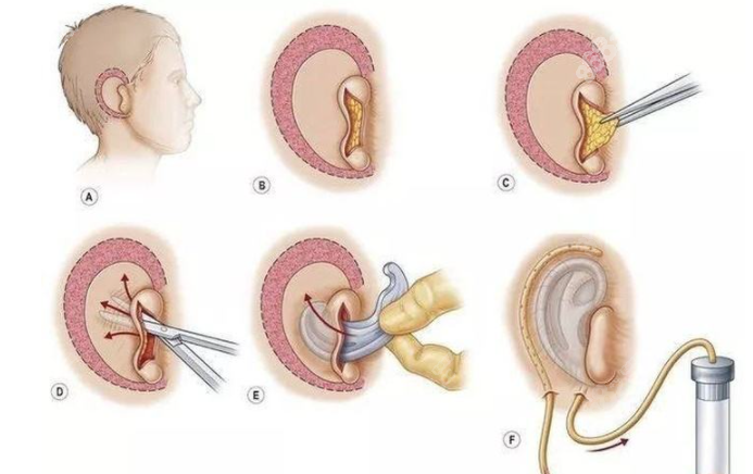 全包法耳再造手术过程图解