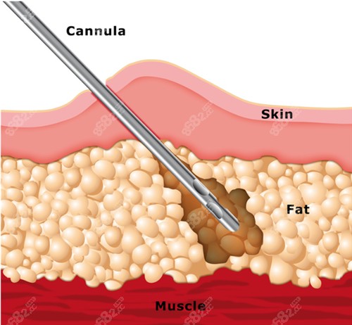 吸脂手术原理图