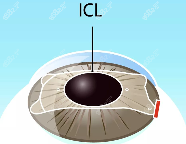 杭州icl晶体植入手术医院排名前十