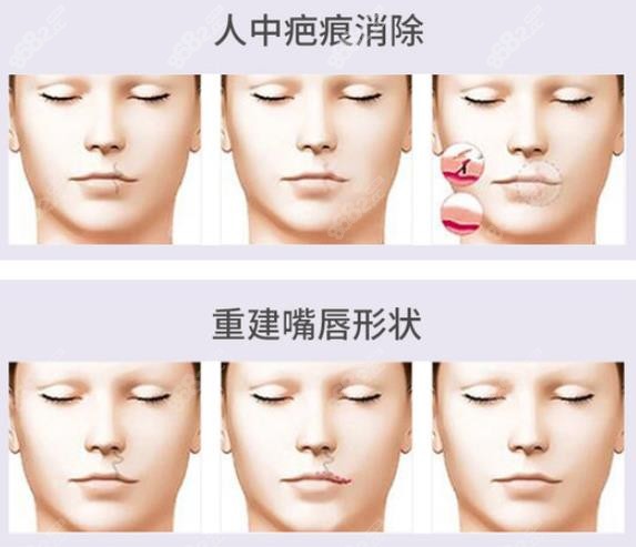 余文林修復唇裂術(shù)后回饋好 www.ekelt.cn