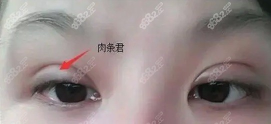 双眼皮失败的实例