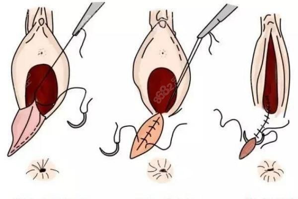 陰道緊縮手術(shù)示意圖