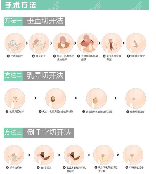 栗勇医生缩胸手术方法多