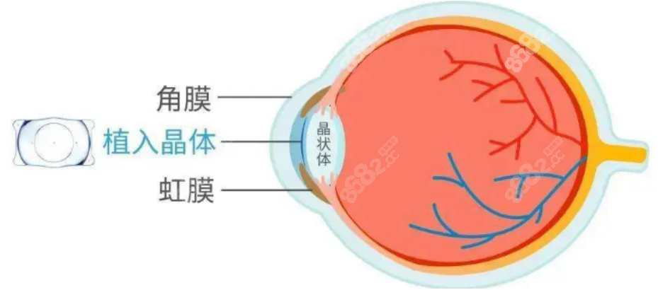 爱尔眼科近视眼手术
