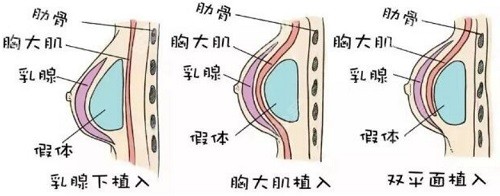 北京美莱医疗美容医院隆胸怎么样？