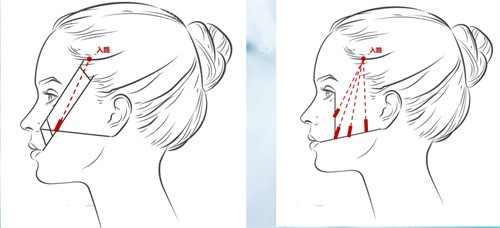 朱云医生微拉美手术好不好