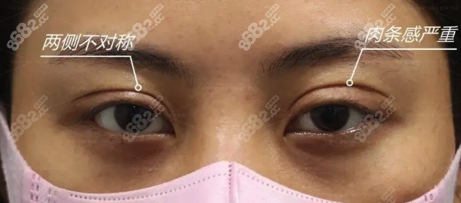 大连爱德丽格刘志刚修复双眼皮好吗