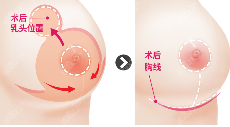 怎么联系到栗勇医生做缩胸手术