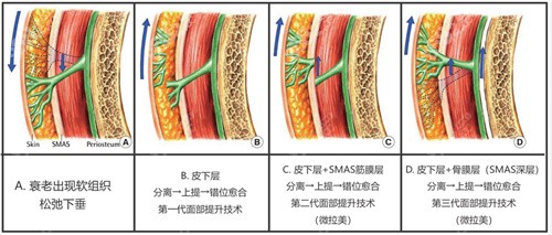 朱云医生微拉美手术原理