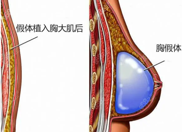 衡阳美莱隆胸技术上的优势