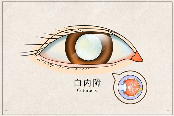 白内障眼睛示意图m.8682.cc