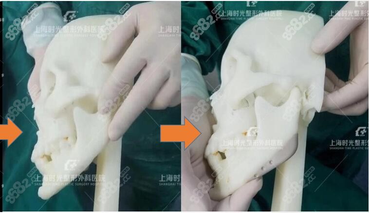 下颌角补骨成功真实图片
