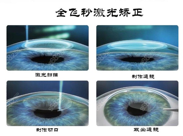 东莞华厦眼科医院梁秀栋医生近视手术好