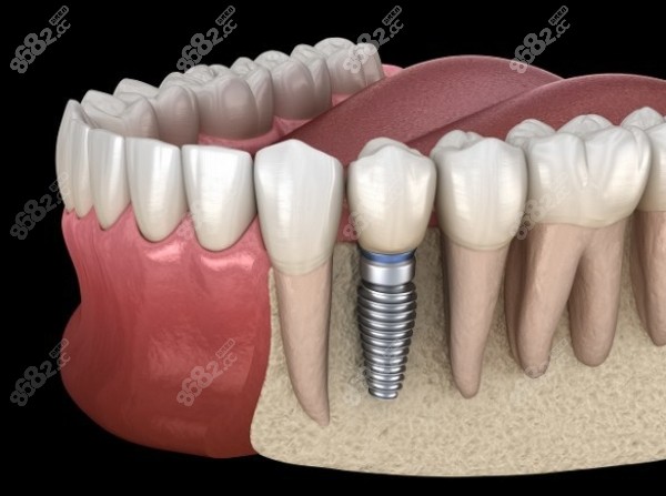 上海正規(guī)醫(yī)院種植牙多少錢收費(fèi)標(biāo)準(zhǔn)