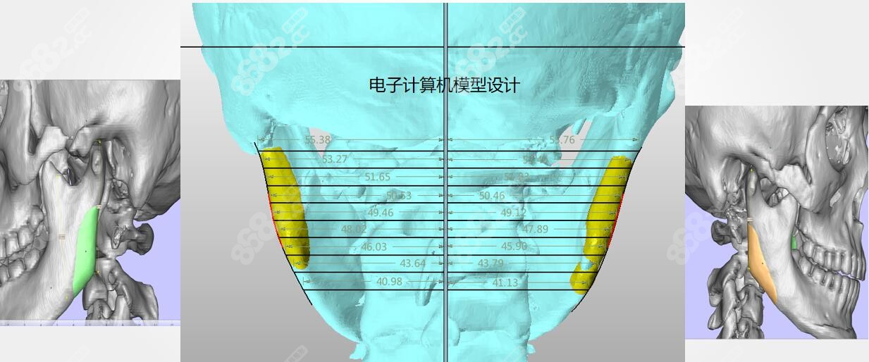 下颌角补骨能贴合肉