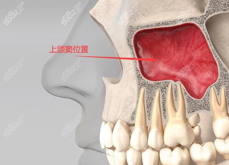 种植牙上颌窦位置www.8682.cc