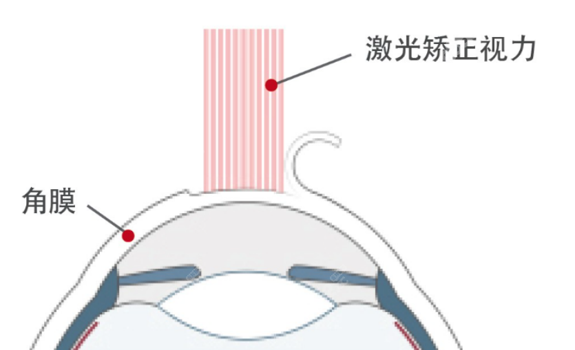 近视眼手术