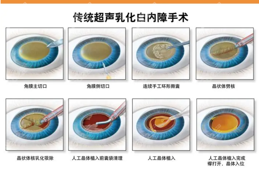 杭州太学眼科董媛技术咋样