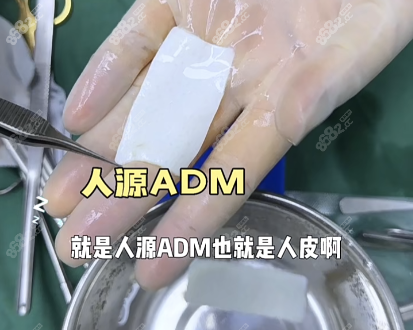 adm填充是什么材料