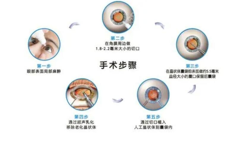 白内障手术过程