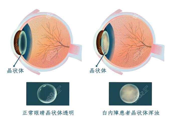 国内免费白内障手术什么时候开始?上海/广东/浙江时间不同,近视眼