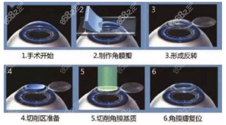 朝聚眼科医院近视眼手术