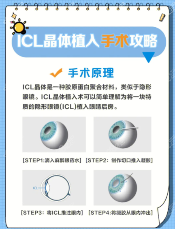 杭州太学眼科董媛医生icl晶体植入近视手术怎么样