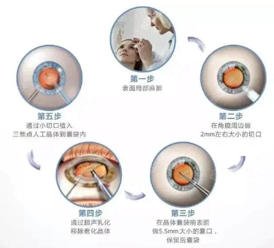 白内障手术的步骤