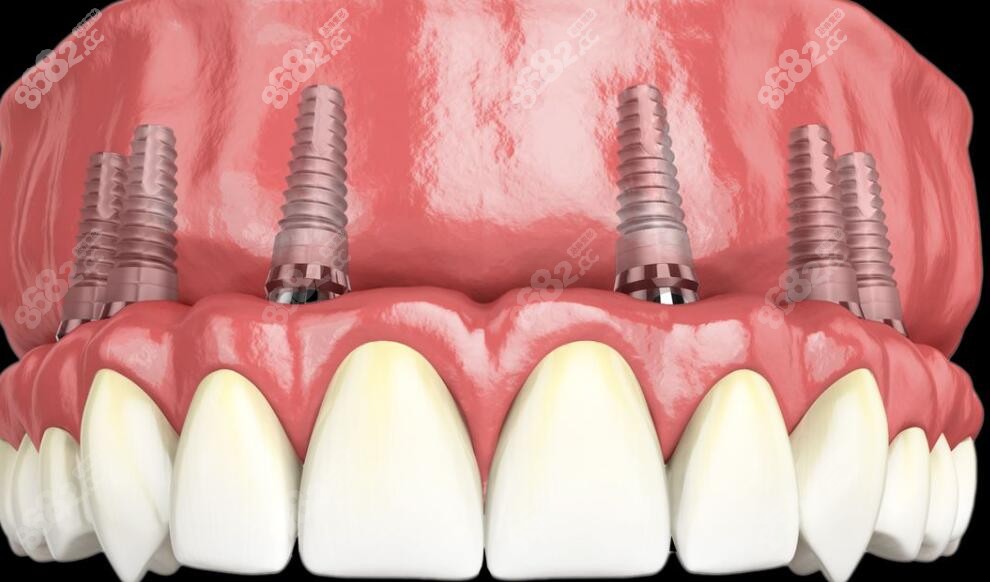 全口种植牙修复图www.8682.cc