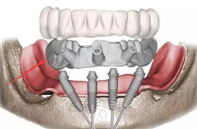 全口种植牙的修复方式