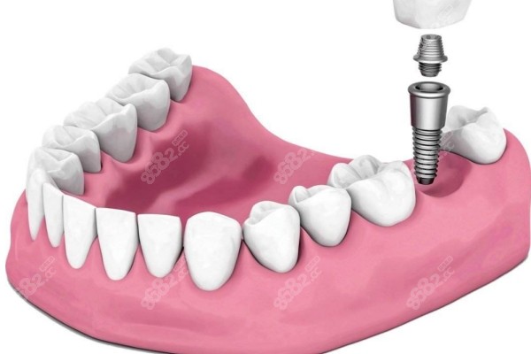 上海正規(guī)醫(yī)院種植牙多少錢價(jià)格標(biāo)準(zhǔn)