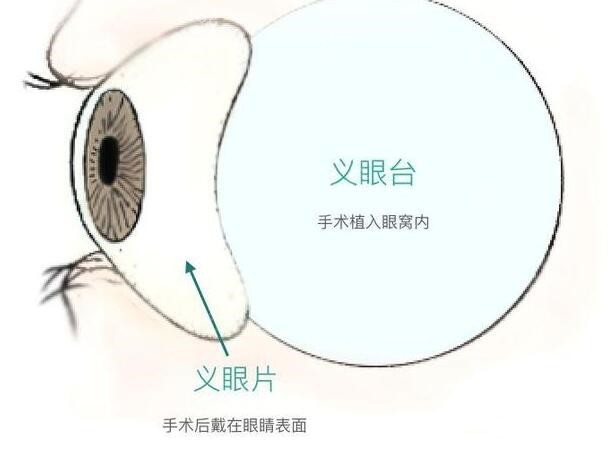 义眼由义眼台和义眼片组成