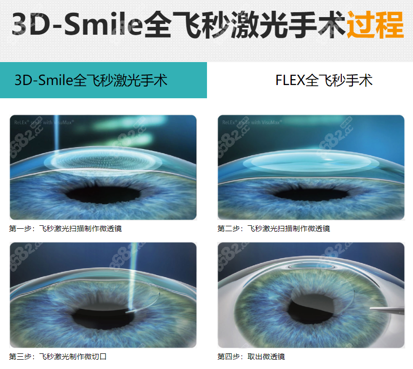 全飞秒近视手术过程8682.cc