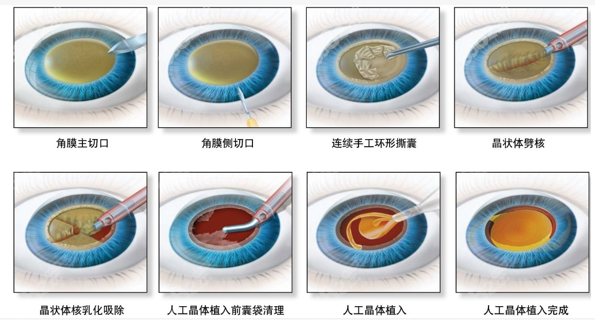 白内障手术过程和步骤