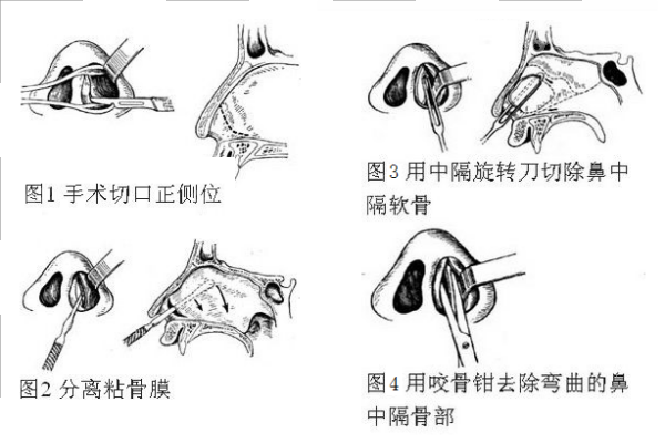 鼻中隔偏曲矫正手术示意图