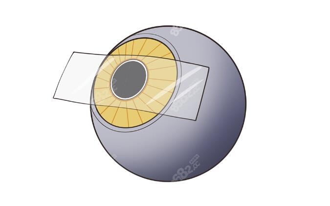 人工晶体植入位置