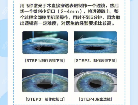 <!--<i data=20240705-sp></i>-->眼科医院做全飞秒手术过程