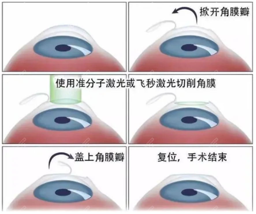 博视眼科医院近视眼手术