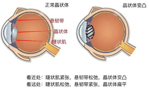 蔡司全视觉三焦点人工晶体的优点